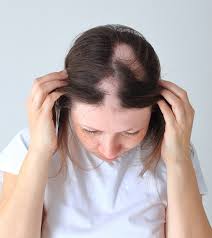 alopecia areata hair loss causes