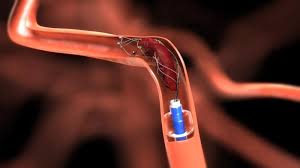 Coronary Atherectomy Devices Global Market Report 2023 - By Product 
(Directional Atherectomy Devices, Orbital