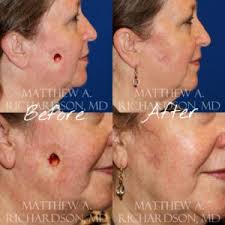 skin cancer reconstruction mohs repair