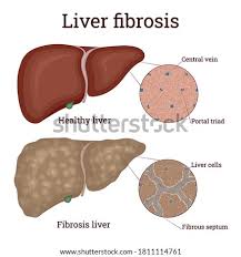Discover the causes of cirrhosis, diagnosis, prevention, and how to. Shutterstock Puzzlepix