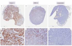Your car donation will help cancer survivors have a longer and better quality of life. Analysis Of Muc4 Expression In Human Pancreatic Cancer Xenografts In Immunodeficient Mice Anticancer Research