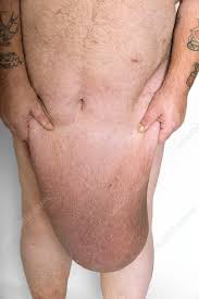 man with excess skin after weight loss