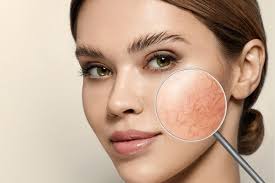 causes of spider veins on the face