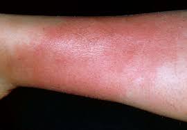Hand, foot, and mouth disease. Common Foot Rashes Symptoms Causes And Treatments