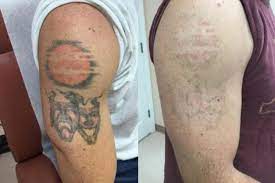 Quickly fade your unwanted tattoo. How Effective Is Laser Tattoo Removal For Colors Guilford Laser Tattoo Removal The Langdon Center