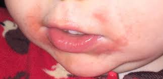 btdt help rash around toddler s mouth
