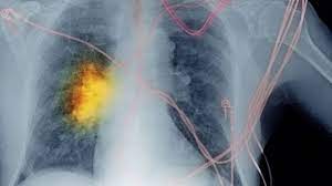 what is non small cell lung cancer