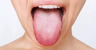 white tongue meaning symptoms