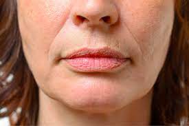 how to get rid of lip wrinkles vargas