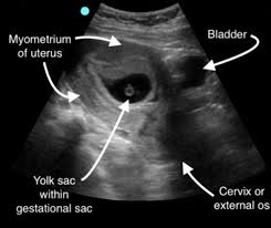 How to perform and interpret a first trimester transabdominal point-of-care  ultrasound | Emergency Medicine Journal