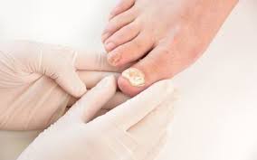 natural remes for fungal nail infections