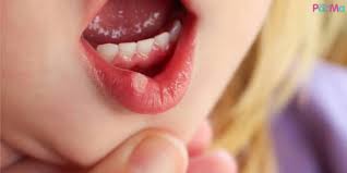 Salah satunya ialah ulser mulut yang biasa terjadi pada bahagian dalam bibir, dalam pipi dan juga di permukaan lidah. Ulser Boleh Potong Selera Makan Beri Anak Ubat Penahan Sakit Syrup Paracetamol Pa Ma