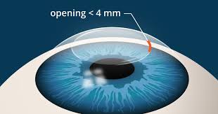 Most patients after lasik or intralase, which are the older, cutting procedures, develop at least some degree of dry eyes, because when you cut the corneal flap, you. Smile Eye Surgery What S Different Than Lasik