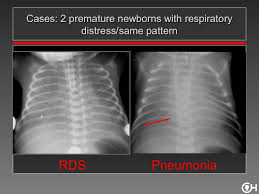 Rds is a respiratory distress syndrome in a newborn. Newborn Chest Reid Neonatal Nurse Practitioner Pediatric Surgery Newborn