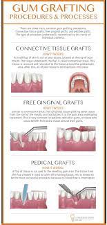 periodontal surgery plano tx gum