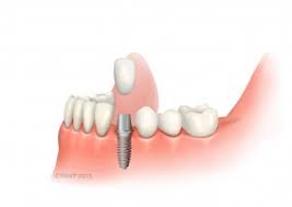 after dental implant treatment