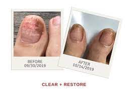 fingernail toenail fungus treatment