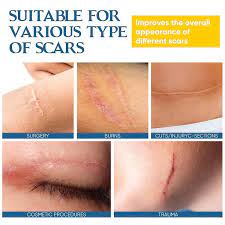 keloid p removal keloid scar