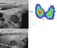 integrated thyroid imaging ultrasound