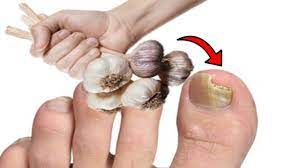 nail fungus using garlic
