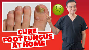 holistic toenail fungus cures part 2