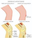 Image result for icd 9 code for osgood schlatter disease