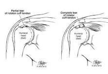 Image result for icd 10 code for right full thickness rotator cuff tear