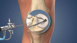 orthopedic surgery for a torn meniscus