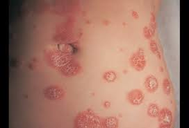 Find expert medical advice about psoriasis, which covers everything from whether psoriasis is contagious and what causes it to treatment options and skin care. Psoriasis Picture Image On Medicinenet Com