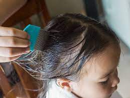 can lice cause hair loss understanding