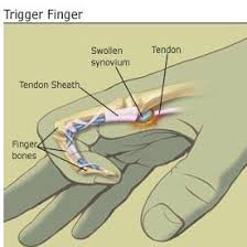 Trigger Finger Active Care Physiotherapy Clinic