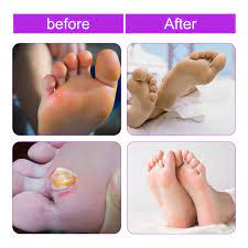 plantar wart remover wart remover