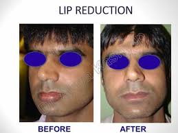 lip reduction at best in delhi