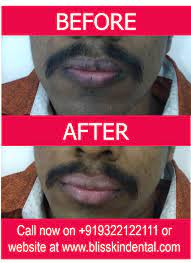 lip enhancing laser treatment bliss skin