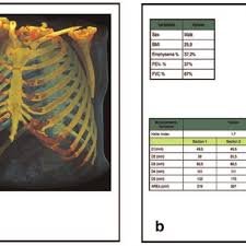 The thoracic cage surrounds and protects the heart and lungs in the thoracic cavity. Rib Cage Morphometric Differences Between A Normal 58 Year Old Male Download Scientific Diagram