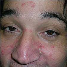rash in hiv positive man mdedge