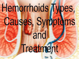 hemorrhoids causes symptoms treatment