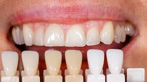 cosmetic dentistry in palm beach