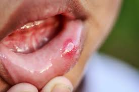 are mouth ulcers caused by allergies