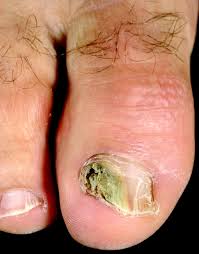 fungal nail infection the bmj
