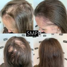 Автор обзора ирина сидорова, фактчекинг евгения русева Scalp Micropigmentation For Alopecia Treatment Smp Ink