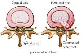 cervical disc herniation singapore