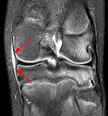 It is also one of the most often injured joints because of its anatomic characteristics, the interrelation of its structural components. Posteromedial Corner Injury Of The Knee Radsource