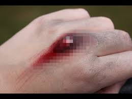 exposed knuckle injury you