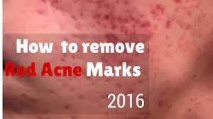 how to remove red marks from acne you