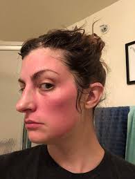 a redditor shared her allergic reaction