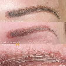 permanent makeup tattoo removal eye