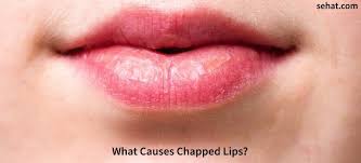 causes chapped lips and how to cure