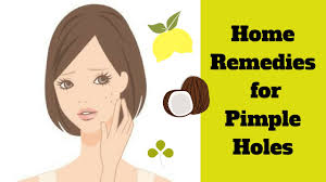 home remes to get rid of pimple holes