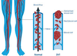 Its function is to stop bleeding and seal the injured tissues. Dvt And Pe Explained Symptoms Fast Facts And Myths